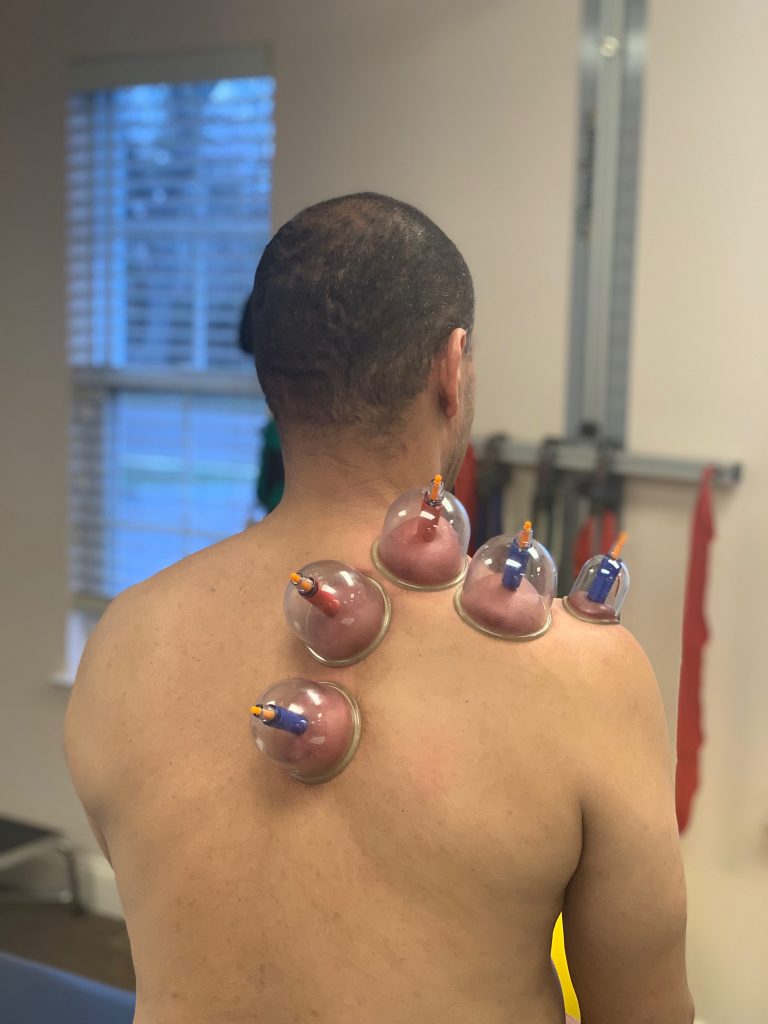 cupping