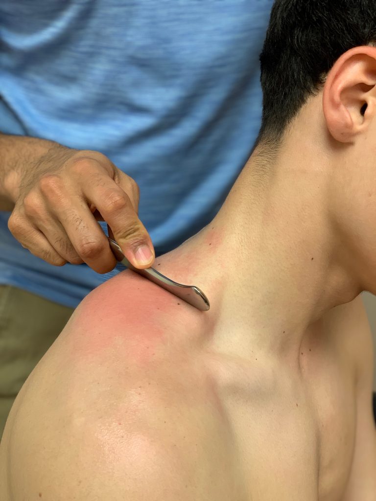 Instrument-Assisted Soft Tissue Mobilization (IASTM)
